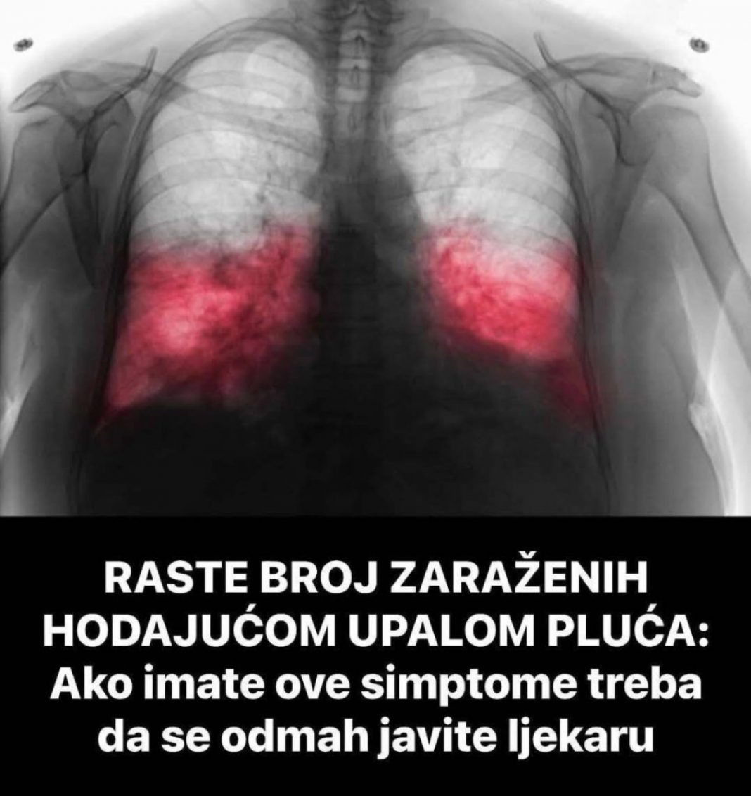 VELlKl BR0J ZARAŽENIH H0DAJUĆ0M UPALOM PLUĆA: Ako imate ove simptome 0DMAH SE JAVlTE D0KT0RU… - featured image