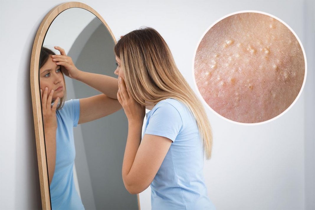 Da li ste čuli za milije - bele kvržice na licu? Evo zbog čega nastaju i kada se morate javiti dermatologu - featured image Da li ste čuli za milije - bele kvržice na licu? Evo zbog čega nastaju i kada se morate javiti dermatologu - featured image