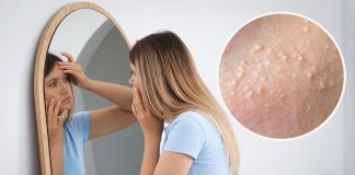 Da li ste čuli za milije - bele kvržice na licu? Evo zbog čega nastaju i kada se morate javiti dermatologu - featured image