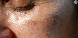 MAZALA JE LICE SA OVIM, STARAČKE PJEGE SU NESTALE: Ovako se zauvijek riješite SMEĐIH MRLJA sa kože, savjetuje poznati dermatolog - featured image
