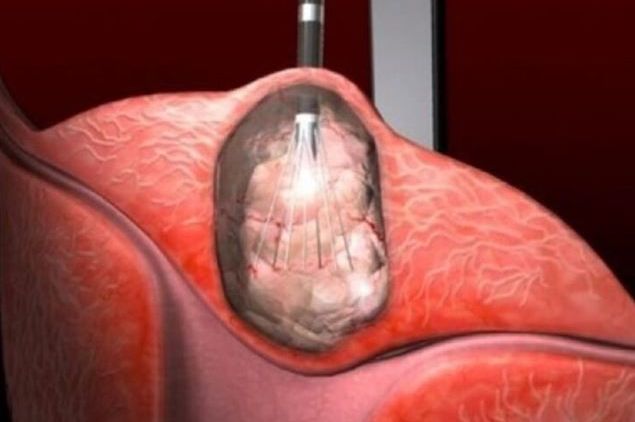 Otkrivena terapija koja djeluje na sve vrste raka: 0vo vaš moze spasiti, požurite - featured image Otkrivena terapija koja djeluje na sve vrste raka: 0vo vaš moze spasiti, požurite - featured image